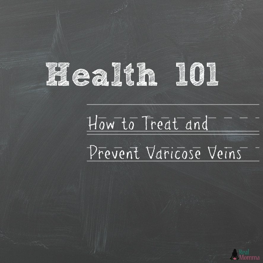 How to Treat and Prevent Varicose Veins